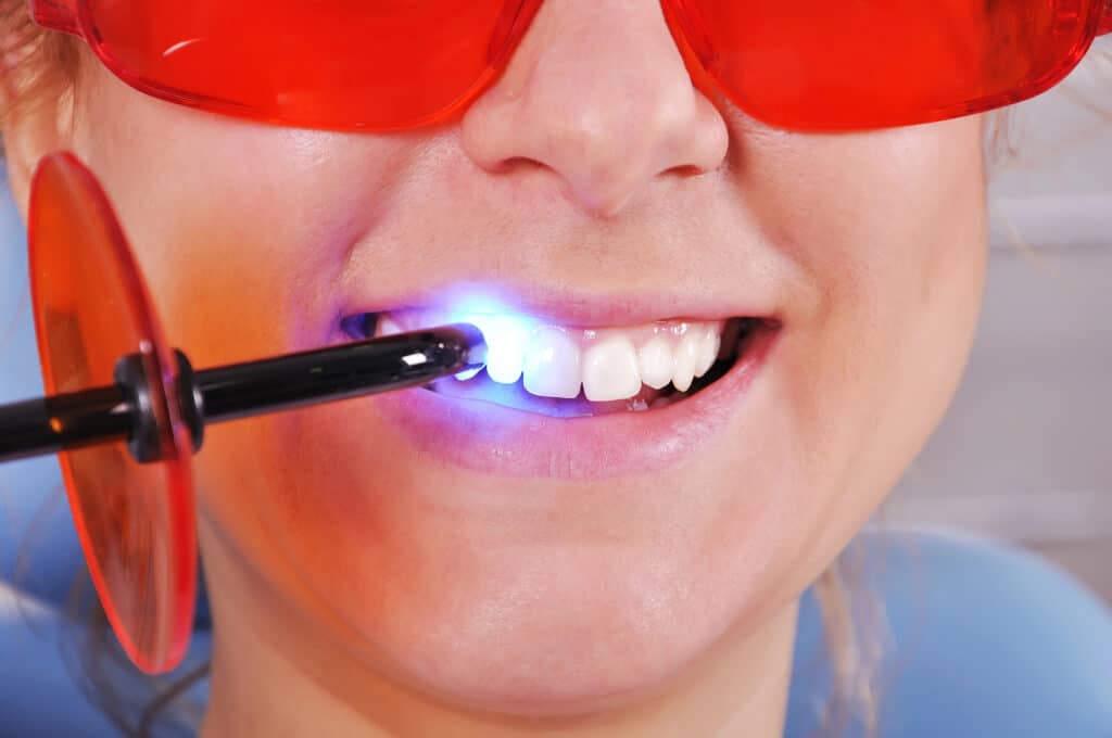 Fillings No One Will Notice