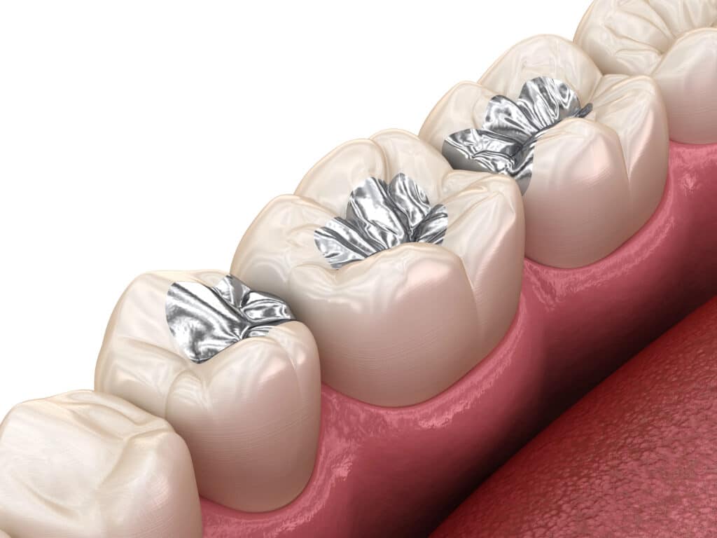 dental sealants