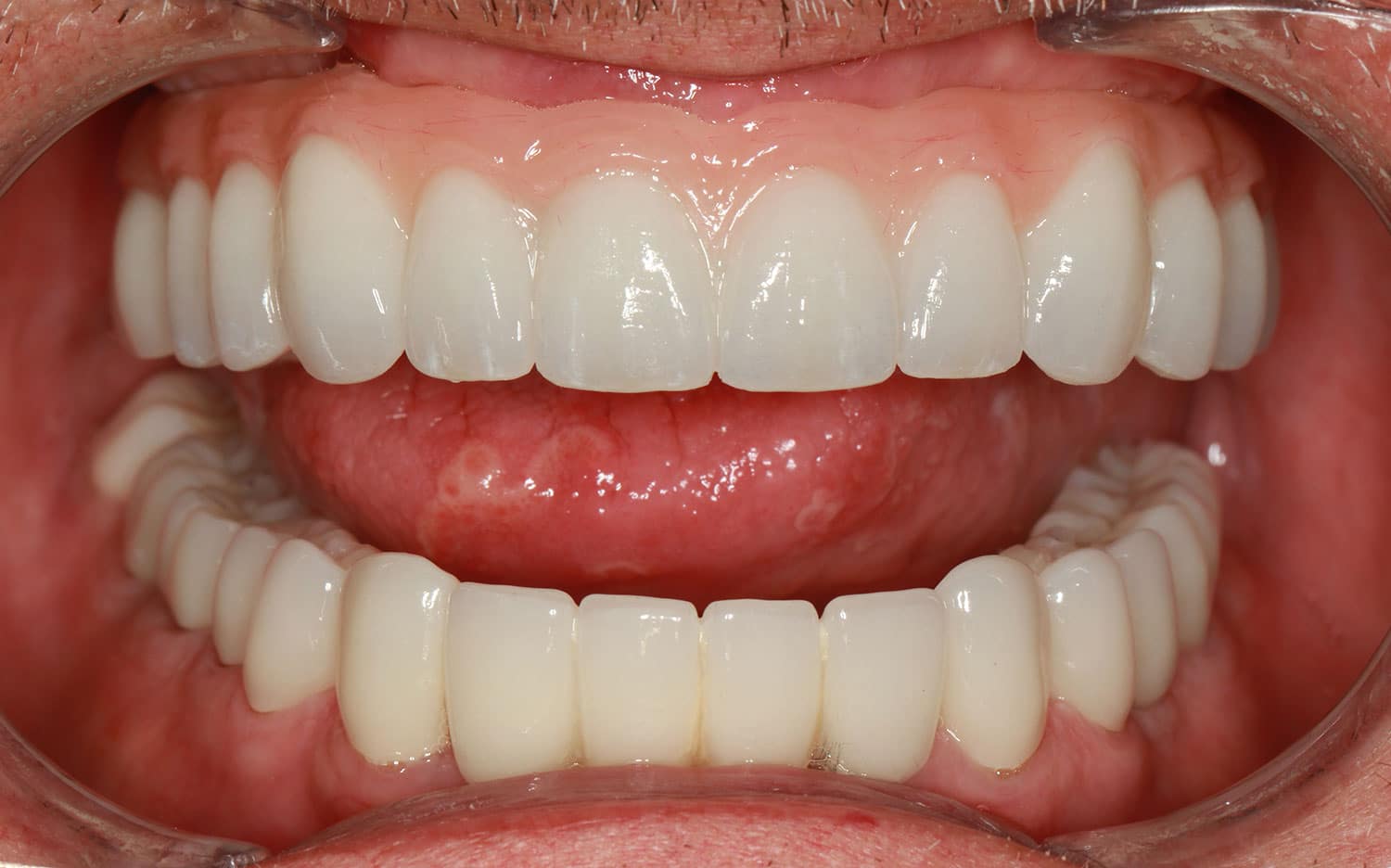 All-on-4 smile design after example