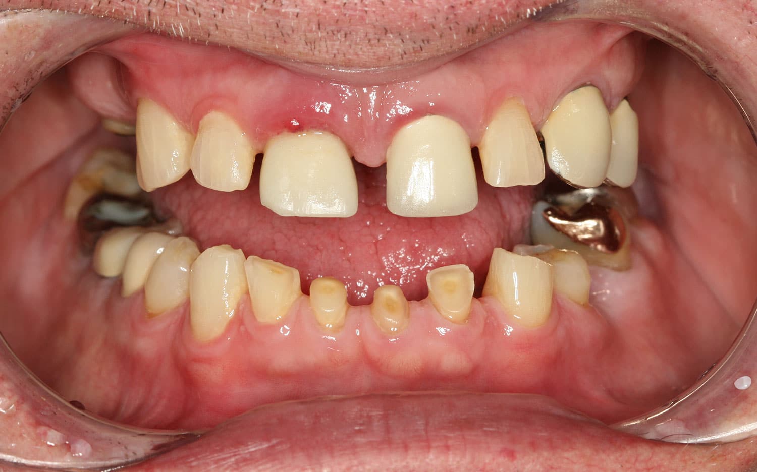 All-on-4 smile design before example