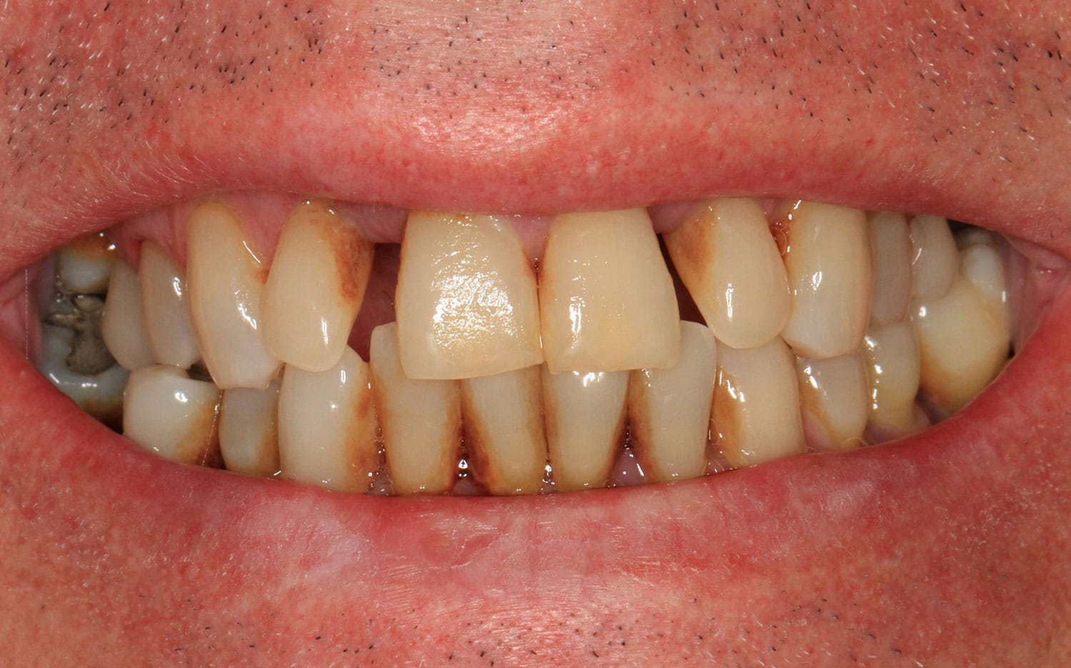All-On-4 implant patient before photo