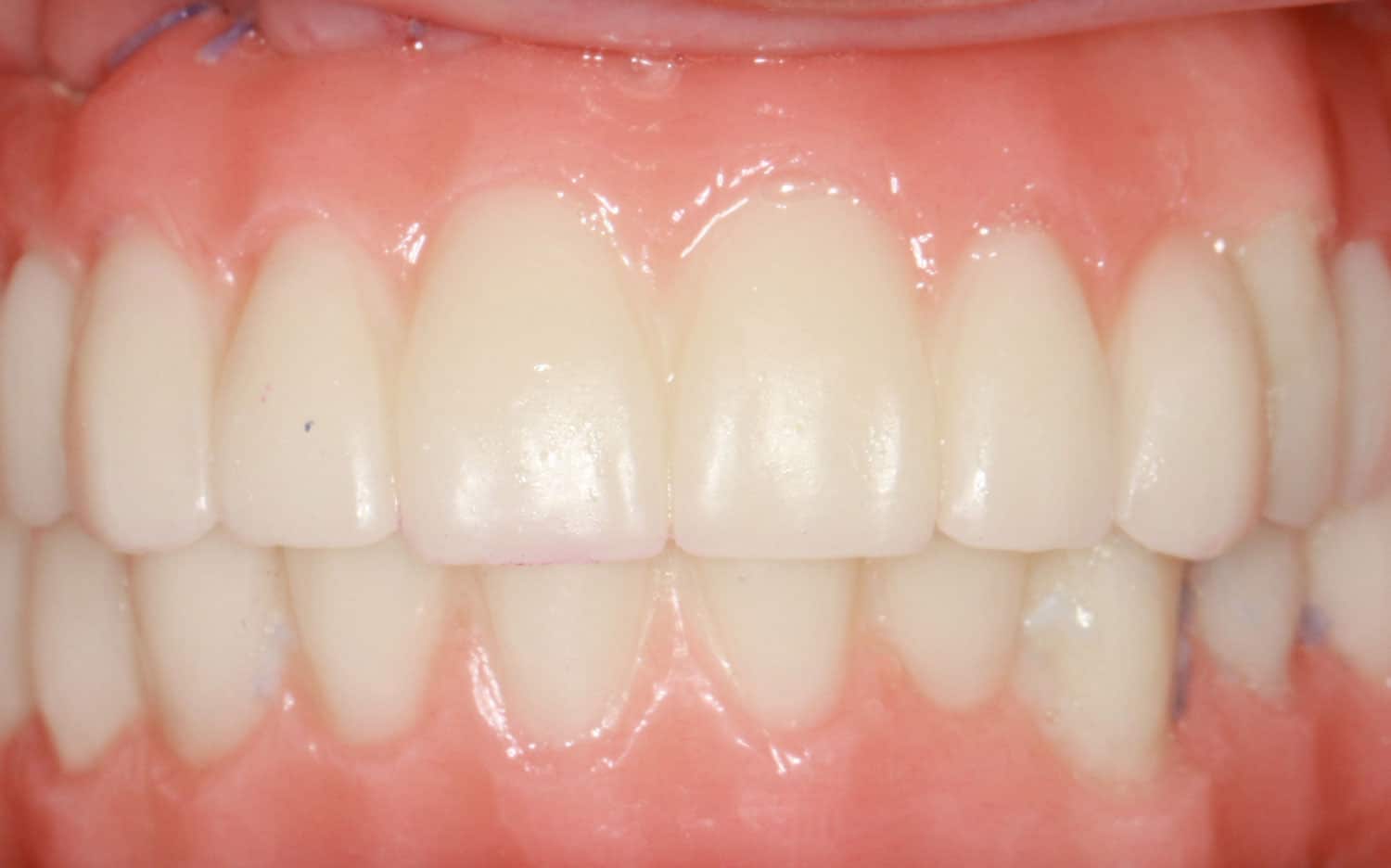 All-On-4 implant patient after photo