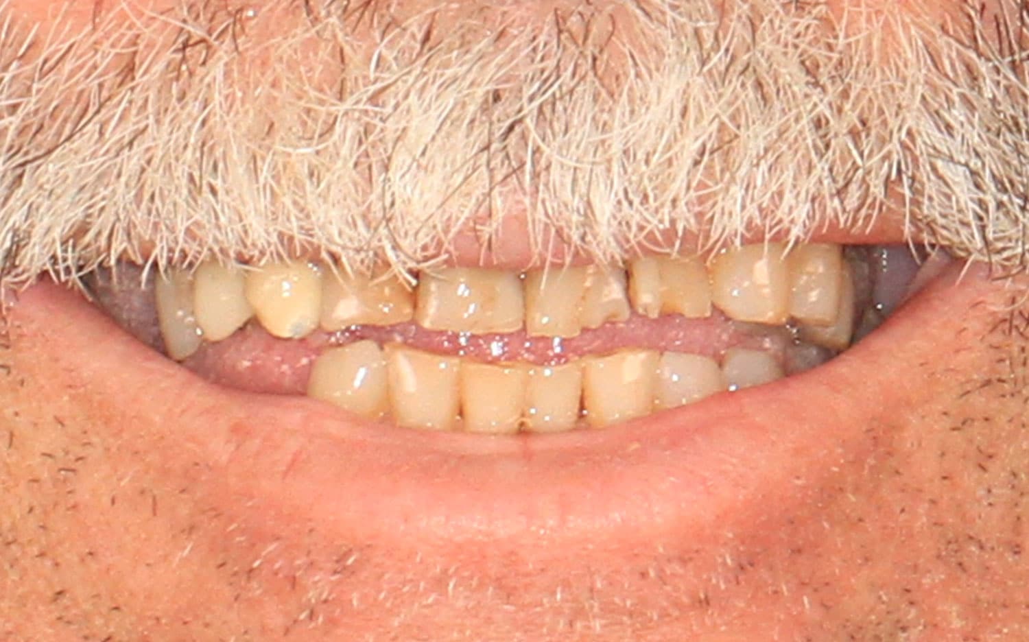 All-On-4 Smile Design - Before
