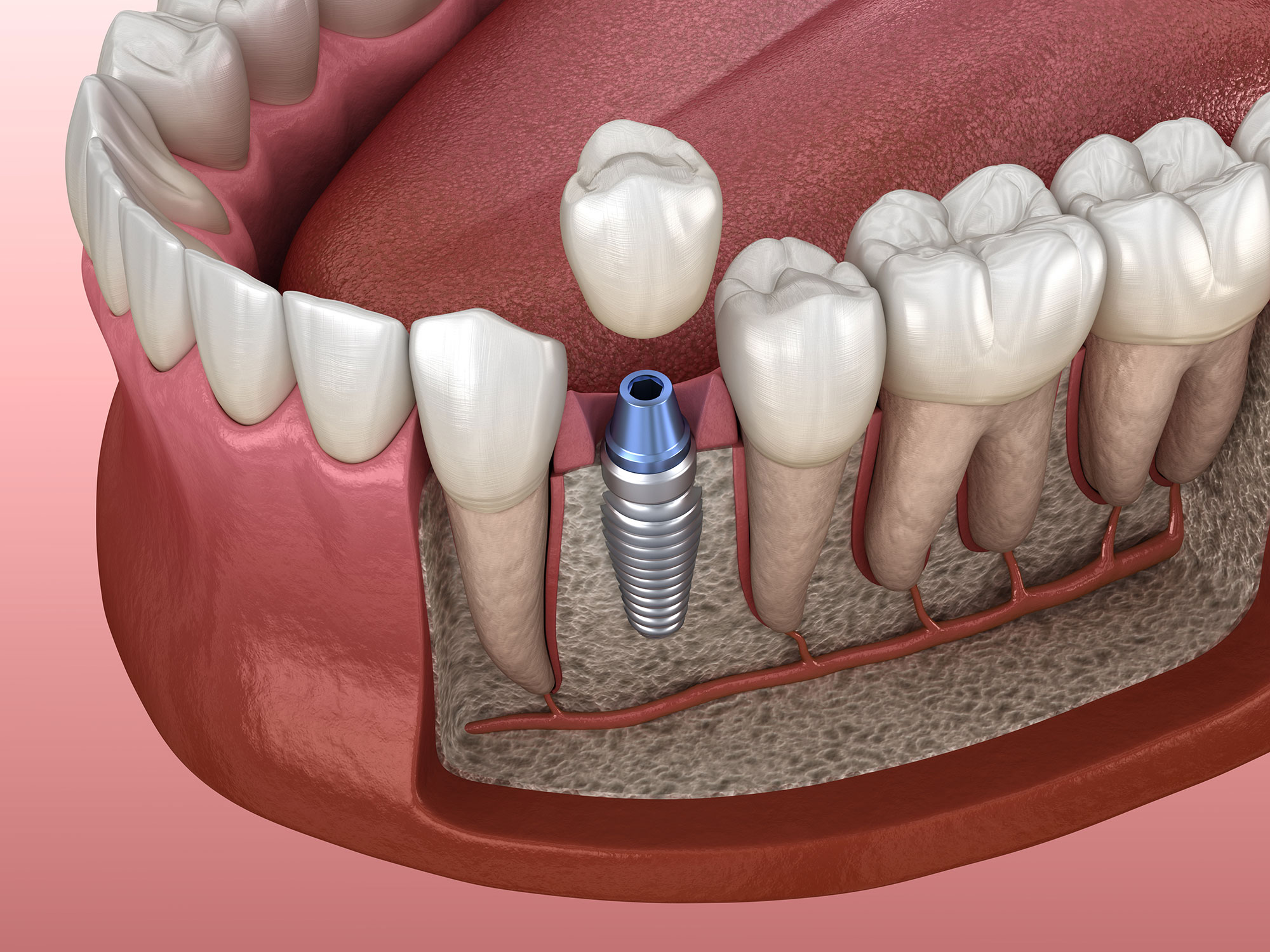 one visit tooth implant