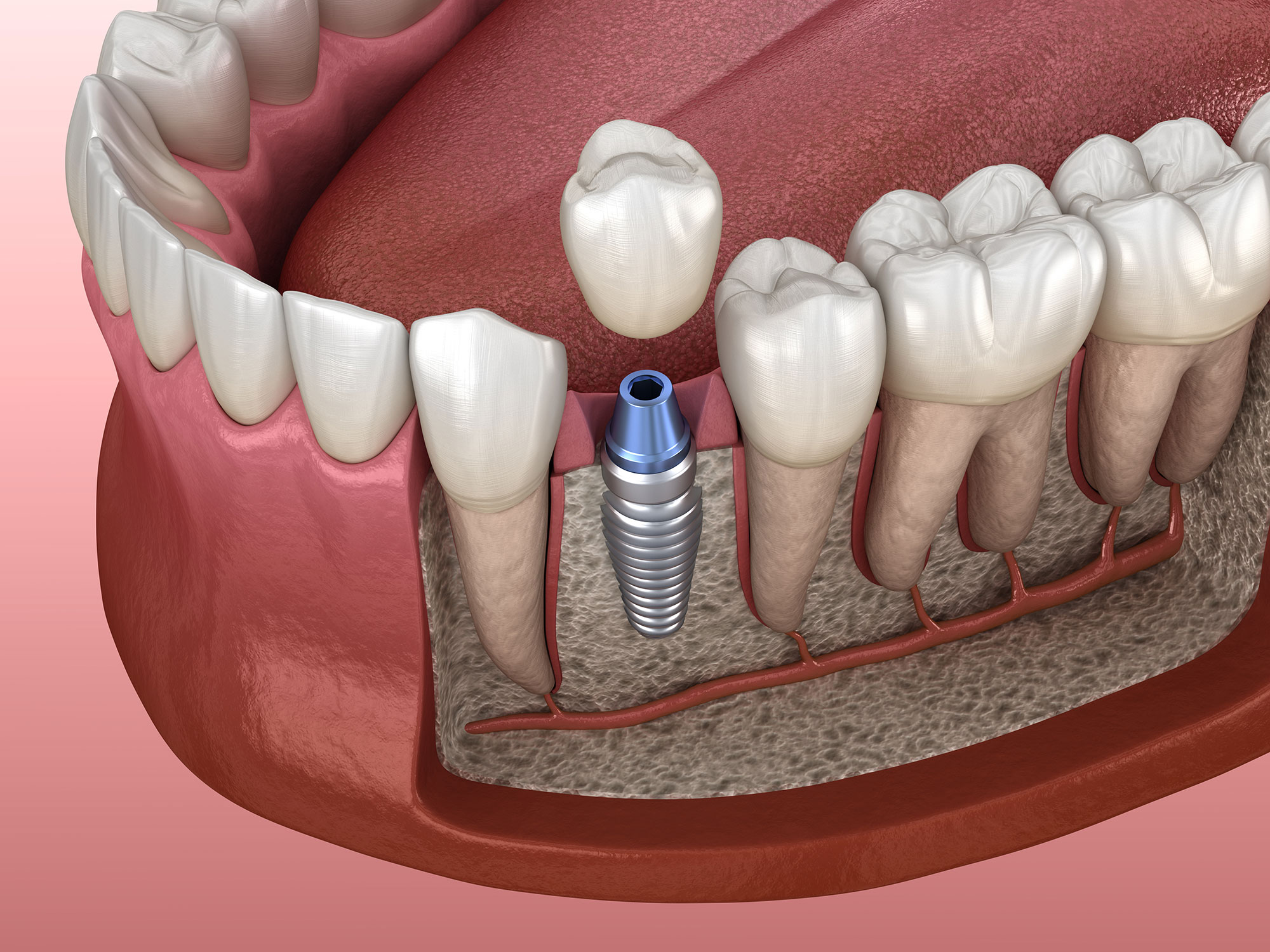 Single Tooth Implant IntegratedDENTAL Woodbury NY