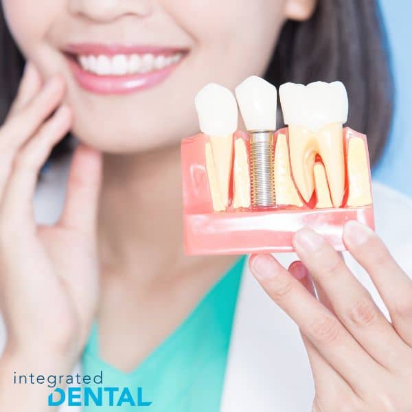 dental implants