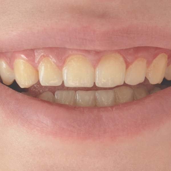 veneers in woodbury ny