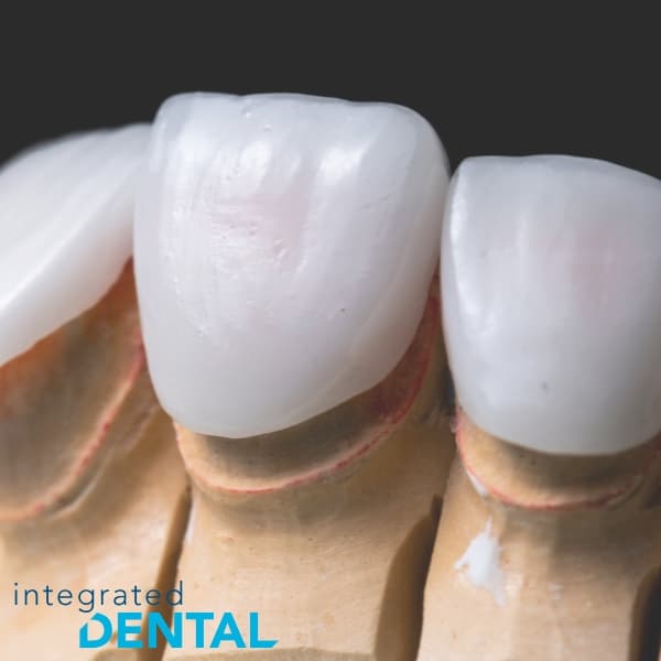 veneers in woodbury NY