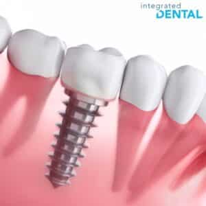 dental implant