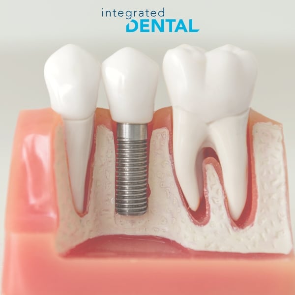 dental implants in plainview